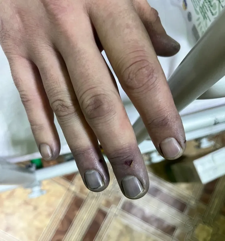 Обмороженнями та госпіталізацією завершилась спроба порушити кордон жителем Полтавщини