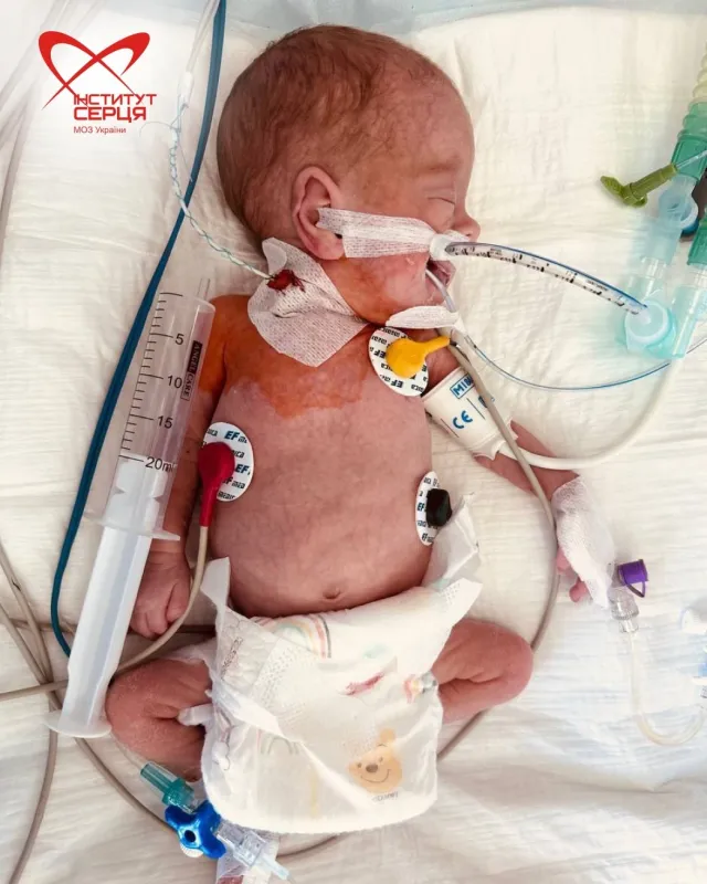 Серце розміром з горішок: медики врятували немовля з Полтавщини вагою 1100 грамів