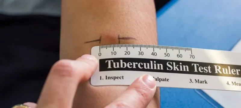 Без проби Манту: Україна переходить на нові методи виявлення туберкульозу